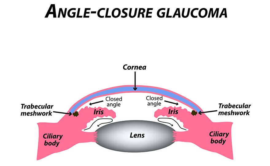 Glaucoma Treatment in Henderson, NV | Medications & Surgery