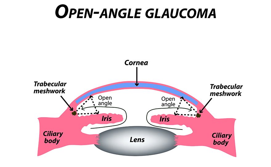 Glaucoma Treatment in Henderson, NV | Medications & Surgery